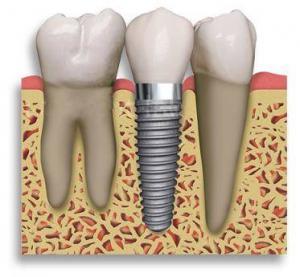 implantes-dentales-de-titanio