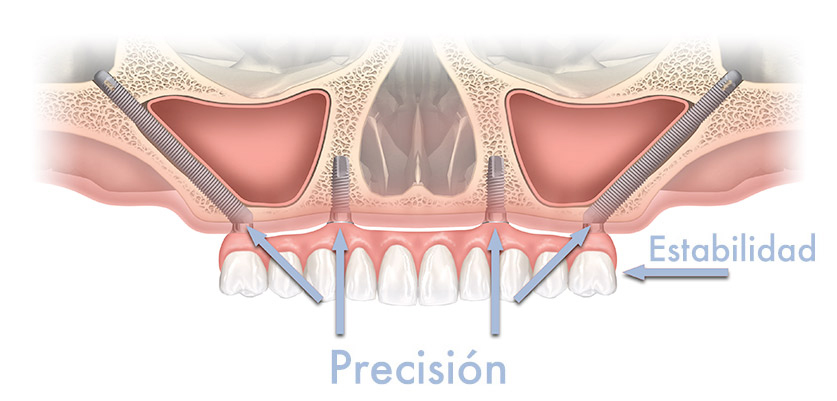 Opciones De Implantes Dentales En Palma De Mallorca Del Grupo Udemax 1ª Parte Grupo Udemax